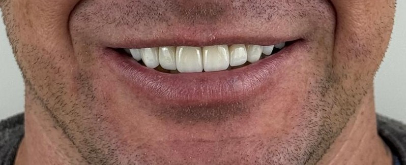 Resultado de tratamento com facetas dentárias
