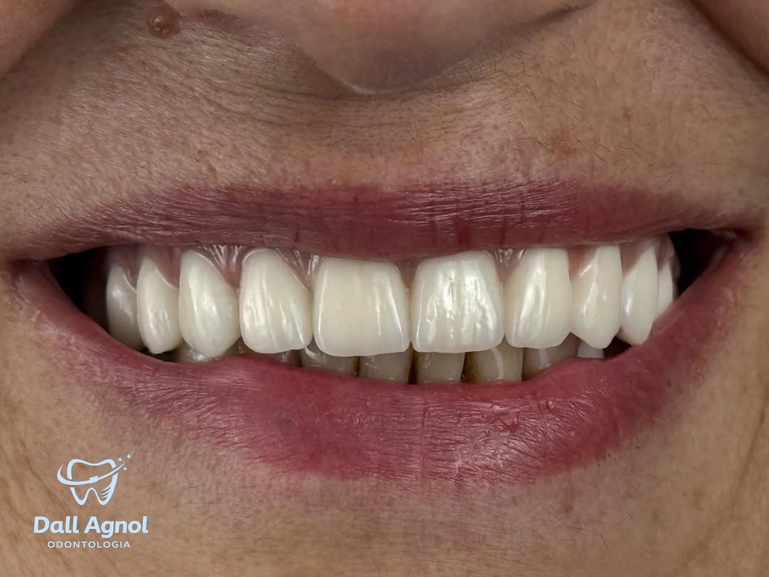Sorriso reabilitado com implantes dentários