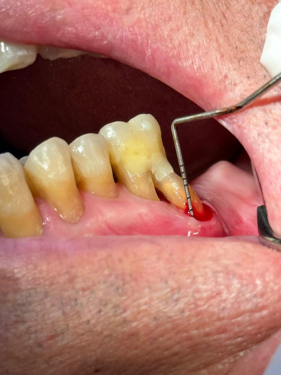 Saúde gengival e tratamento periodontal